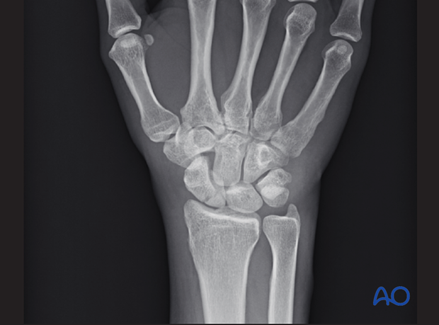 Scaphoid fracture –  this PA x-ray shows only a tiny fracture of the proximal pole of the scaphoid.