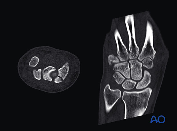 Scaphoid fracture –  this CT scan reveals the degree of displacement.