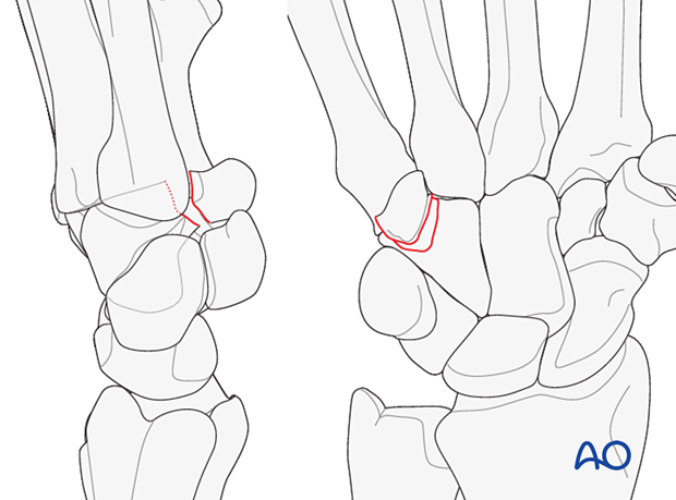 Hamate hook fracture