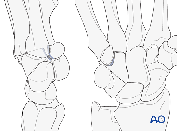 Hamate hook fracture - nonunion