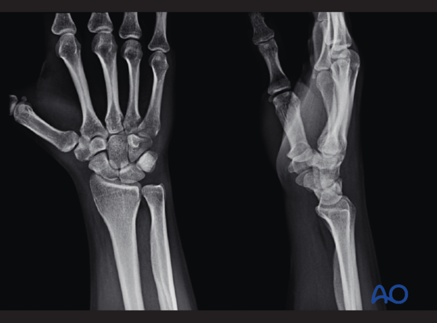 Hamate hook fracture - conventional x-rays do not always show the fracture