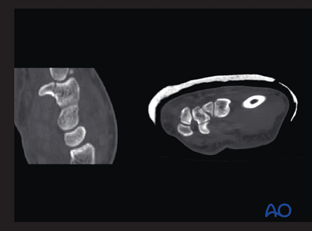 Hamate hook fracture - A CT scan may be helpful to confirm the diagnosis and show the magnitude of any displacement