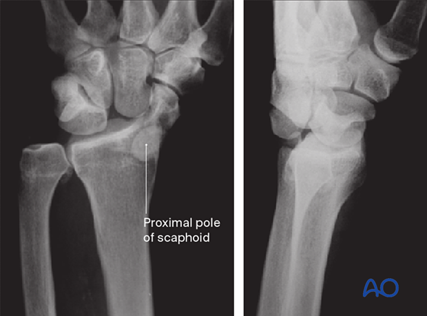 X-rays showing a transscaphoid perilunate fracture-dislocation