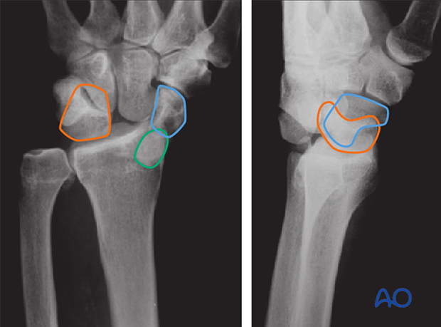 X-rays showing a transscaphoid perilunate fracture-dislocation. The lines show the lunate (orange), the distal scaphoid fragment (blue), and the proximal scaphoid fragment (green)