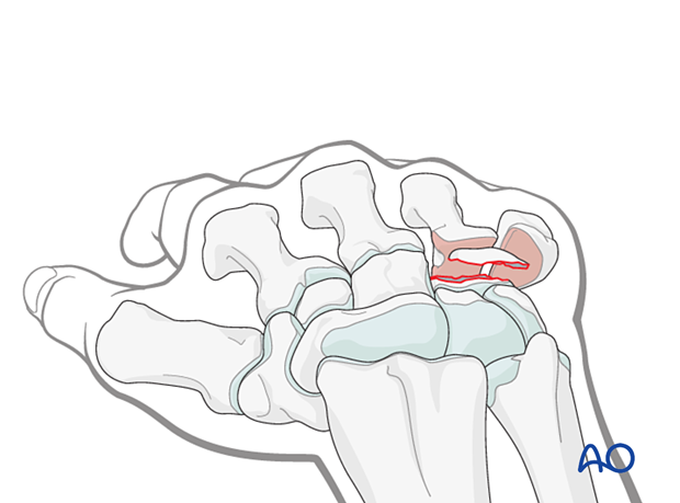 A coronal hamate fracture with dislocation of the 4th and/or 5th CMC joint.