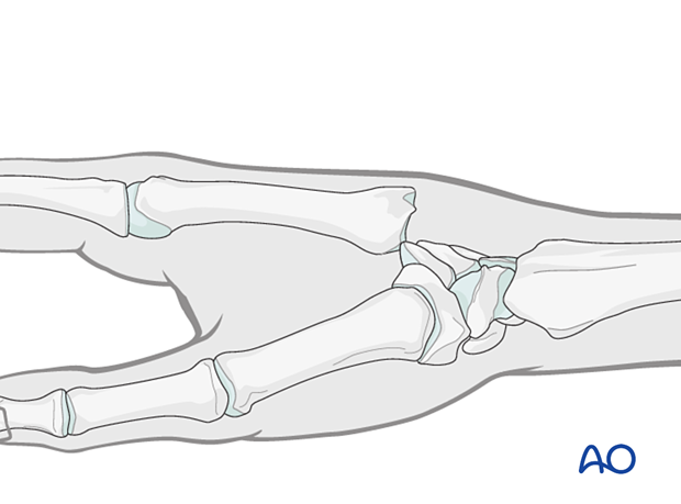 Carpometacarpal joint dislocation