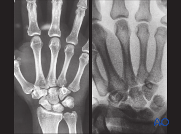 Dislocation of the 5th CMC joint before and after reduction