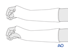 Splinting of the wrist in a scaphoid and Colles cast