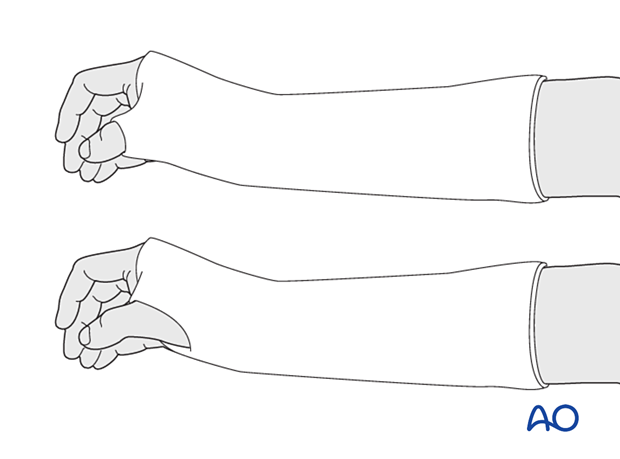 Wrist immobilized in a below-elbow cast, with thumb included in a position of slight opposition (“scaphoid cast”)and  with the thumb free