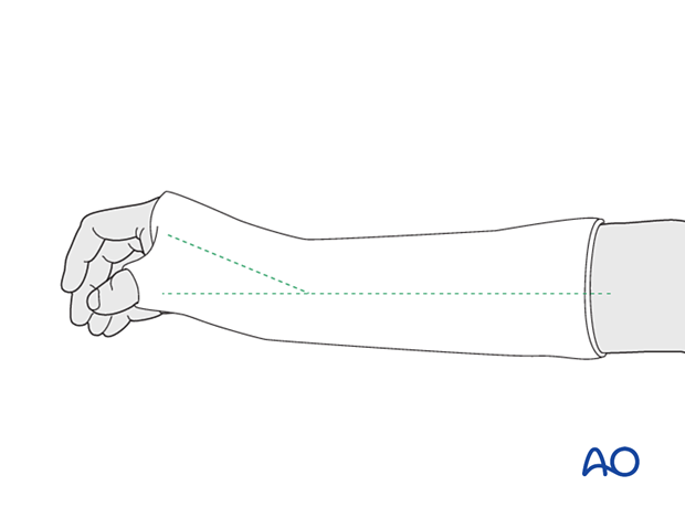 Wrist immobilized in a below-elbow cast, with the wrist slightly extended