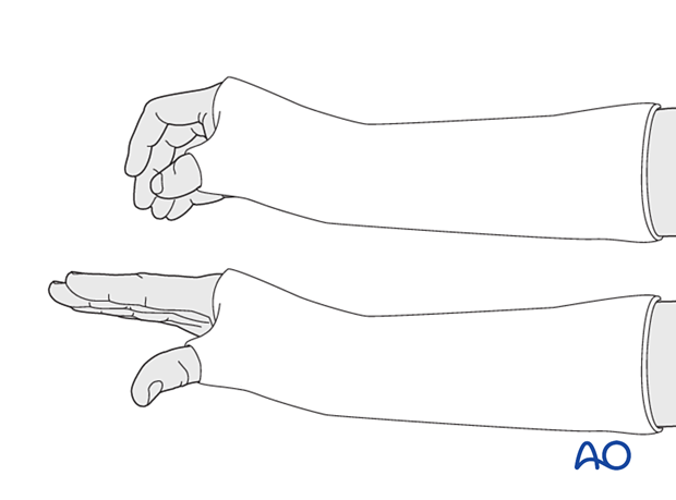 Circumferential below-elbow cast allowing complete movement of the MCP joints of the fingers and the IP joint of the thumb