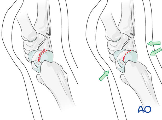 Closed reduction of a scaphoid fracture with cast molding