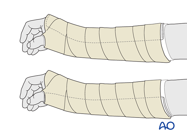 Dorsal and palmar splinting of the wrist in slight extension