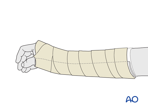 Palmar splinting of the wrist