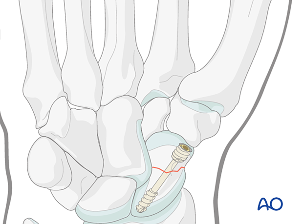 Scaphoid waist fracture fixed with a cannulated headless compression screw