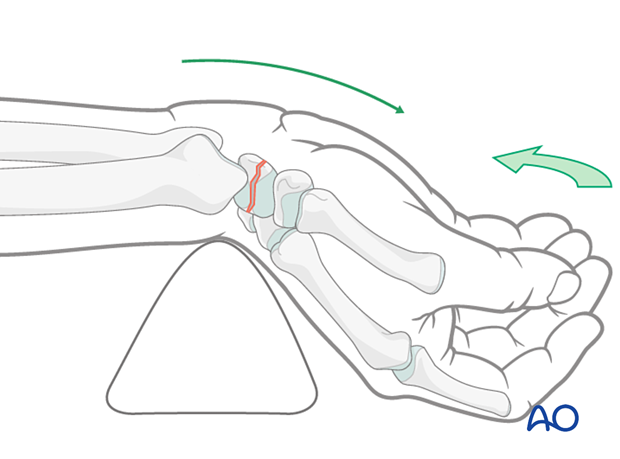 Hyperextension and ulnar deviation of the wrist facilitates reduction of a scaphoid fracture.