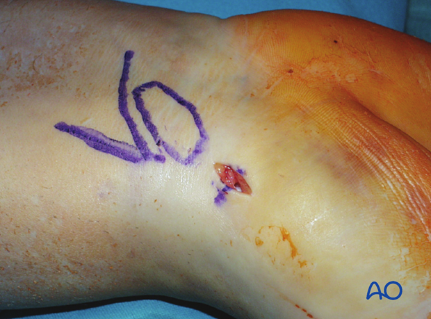 Scaphoid waist fracture - percutaneous screw fixation through a palmar approach: short stab incision distal to the scaphotrapezial joint