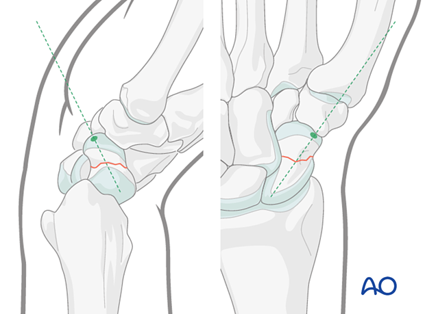 Scaphoid waist fracture - insertion point for the guide wire