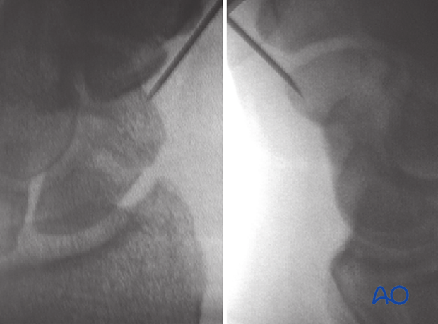 Scaphoid waist fracture - percutaneous screw fixation through a palmar approach: insertion point and tip of the guide wire shown in AP and lateral views