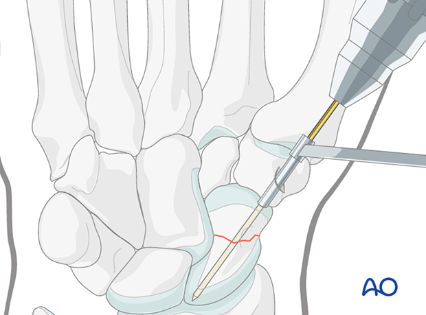 Scaphoid waist fracture - percutaneous screw fixation through a palmar approach: insertion of guide wire through a drill guide