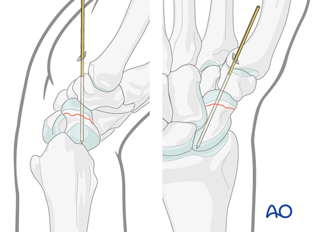 Scaphoid waist fracture - percutaneous screw fixation through a palmar approach: sometimes access to distal entry point can only be gained by a limited excavation of the edge of the trapezium or through it