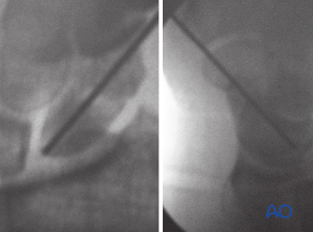 AP and lateral views of a guide wire in a transverse scaphoid waist fracture 