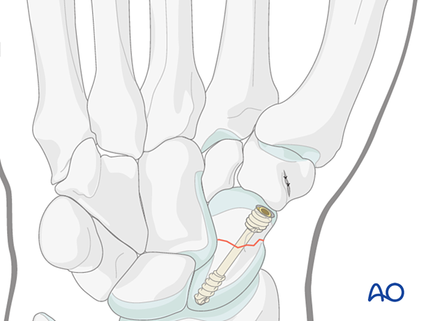 Scaphoid waist fracture fixed with a cannulated headless compression screw.