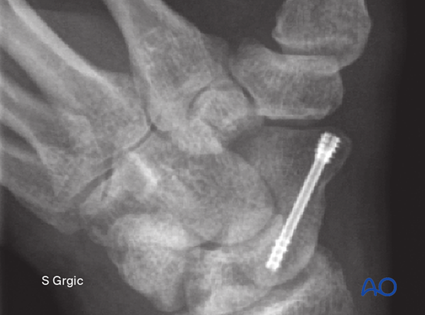 Case of screw fixation of a transverse scaphoid waist fracture