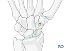 Scaphoid waist fracture with retrograde headless compression screw