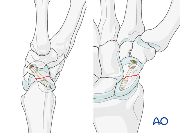 Scaphoid waist fracture - screw placement with a palmar approach