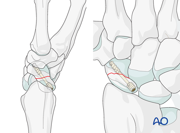 Scaphoid waist fracture - in proximal pole fractures and most waist fractures, antegrade screw insertion using a dorsal approach allows for a more accurate and reliable center-axis screw placement