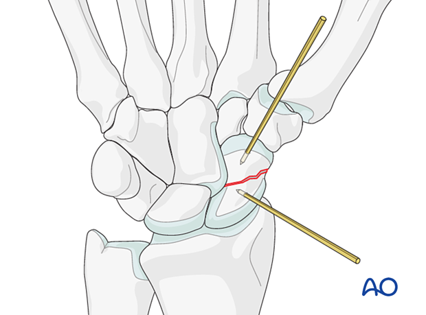 Scaphoid fracture – using K-wires as joysticks