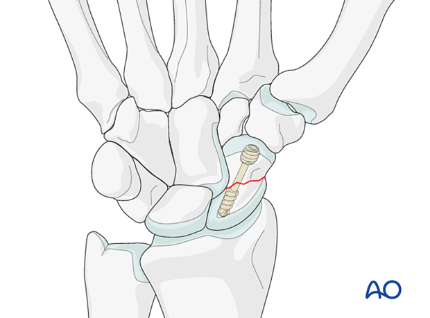 Scaphoid fracture – optimal screw position