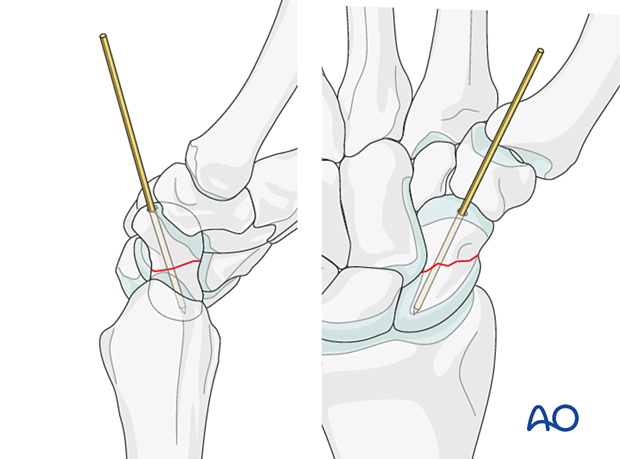 Scaphoid fracture – insertion of guide wire prior to screw fixation