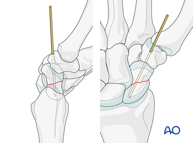 Scaphoid fracture – sometimes access to a distal entry point for a device can only be gained by a limited excavation of the edge of the trapezium or through it