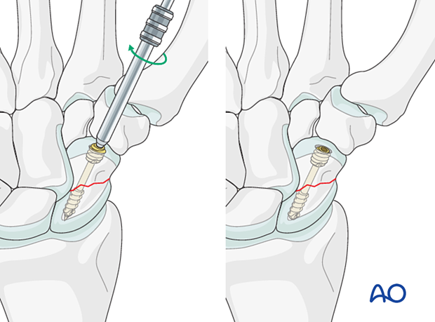 Scaphoid waist fracture – screw insertion