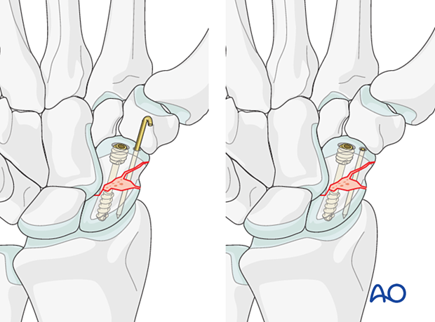 Scaphoid waist fracture – screw insertion in fractures with bone graft or comminution