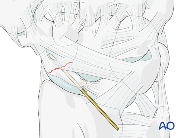 Scaphoid waist fracture – guide-wire insertion