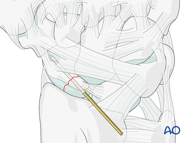 Scaphoid Proximal pole fracture – guide-wire insertion