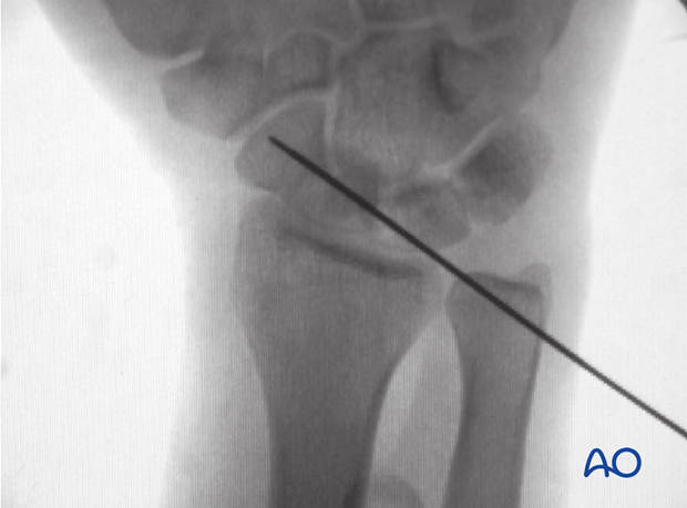 Scaphoid fracture – guide-wire insertion: confirmation of position with image intensifier 