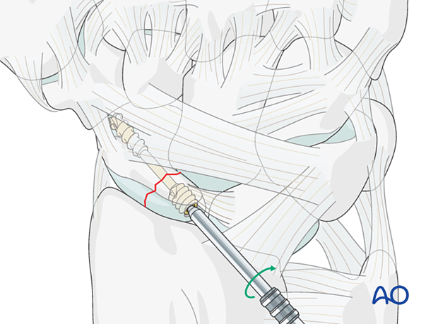 Scaphoid fracture – headless compression screw insertion