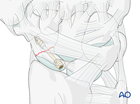 Scaphoid fracture fixation with antegrade headless compression screw