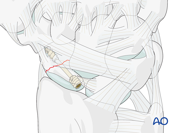 Scaphoid fracture – Headless screw fixation