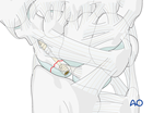 Scaphoid proximal pole fracture – headless compression screw used in an antegrade fashion through a dorsal approach