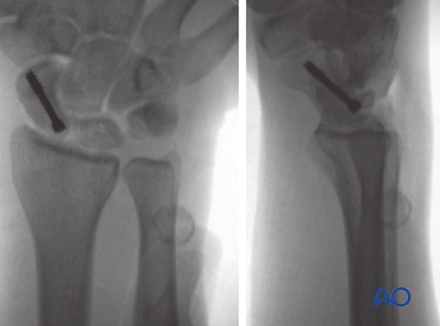 Case with antegrade screw fixation of a scaphoid waist fracture