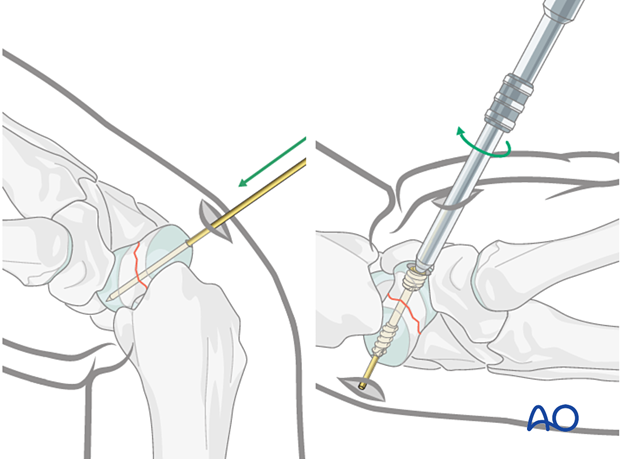 Scaphoid waist fracture – fixation with headless compression screw