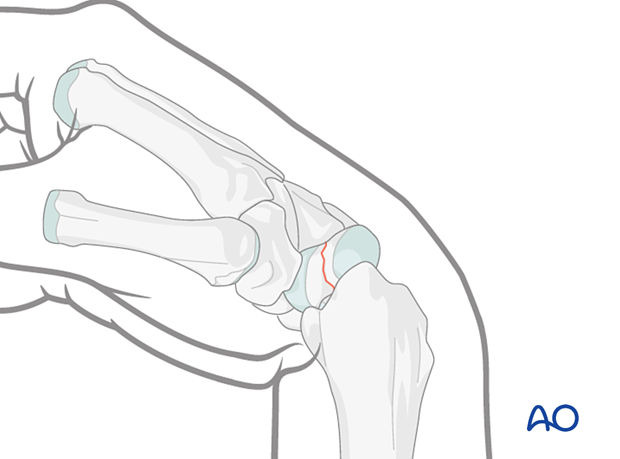 The wrist is flexed palmarly to exposure the proximal scaphoid during scaphoid – Undisplaced waist fracture – Percutaneous screw fixation