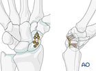 Scaphoid waist ORIF - Palmar plating