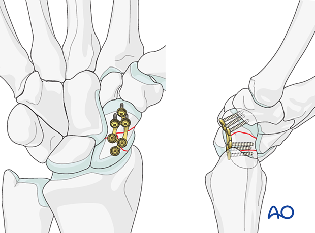 Multifragmentary scaphoid waist fracture - Palmar plating