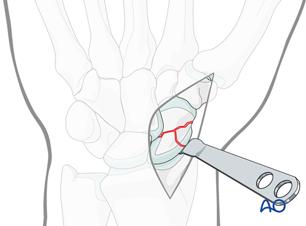 Scaphoid displaced waist fracture – exposing the radial aspect of the scaphoid